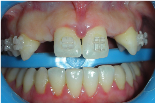 implantogia dentale