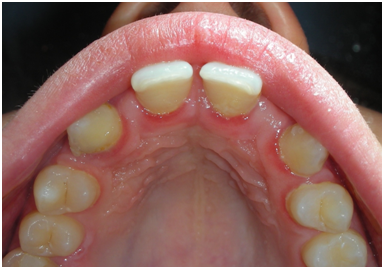 implantologia dentale 