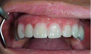 implantologia dentale 