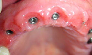 implantologia dentale studio dentistco