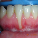 ortodonzia invisibile studio dentisco 
